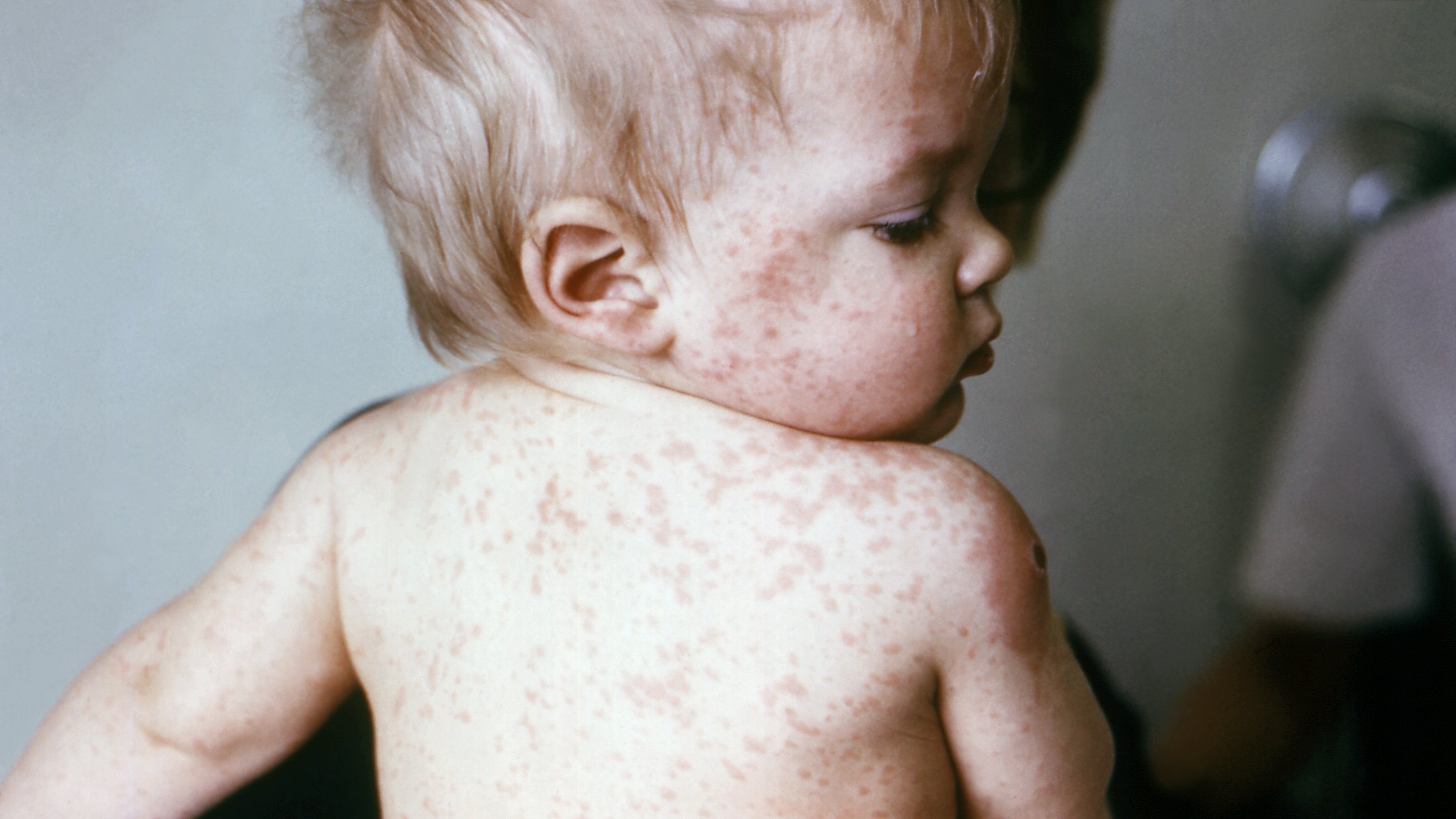 Washington measles case