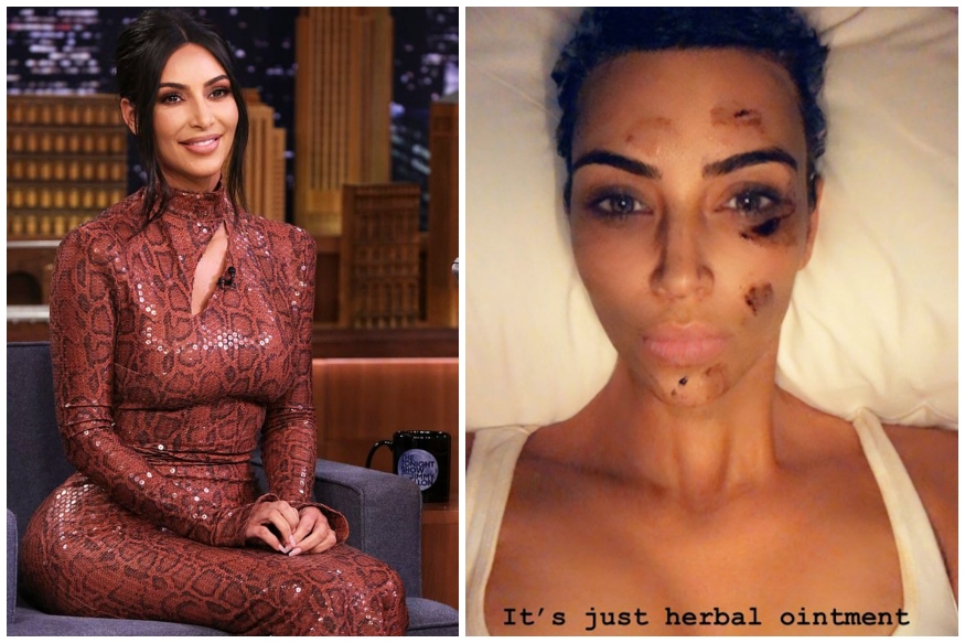 Kim Kardashian is Suffering From Psoriasis