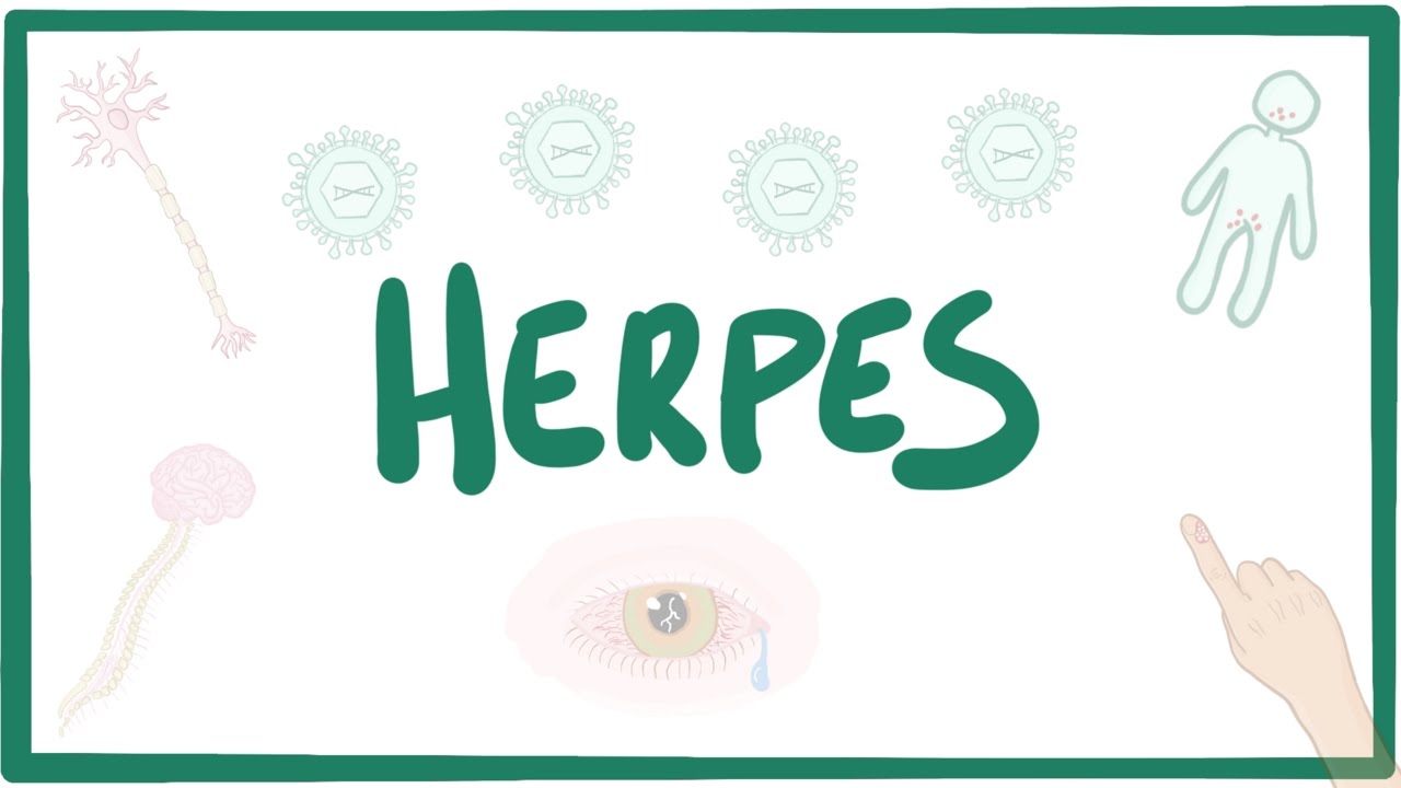 This new cure of Herpes can stop the infection from spreading