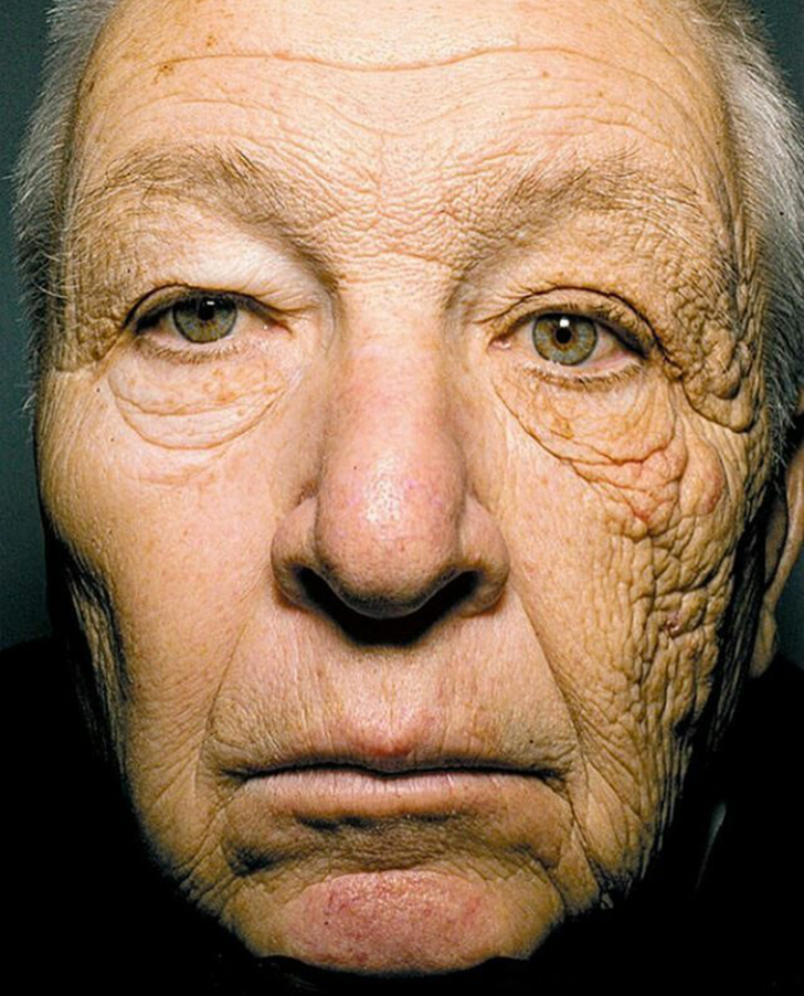 This man's skin damage on the left side of his face after 28 years of truck driving