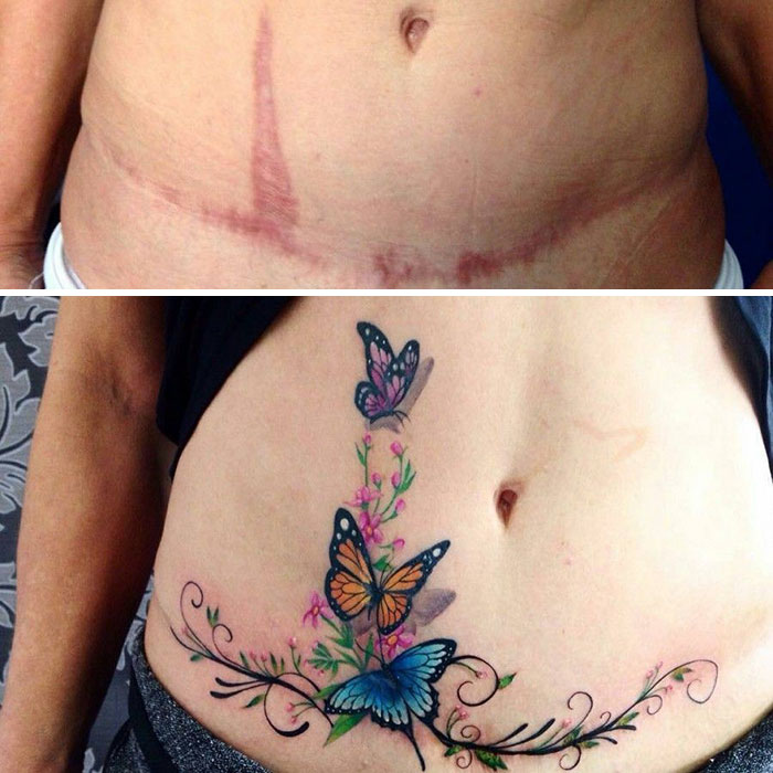 20+ People Who Brilliantly Covered Up Their Birthmarks And Scars With Tattoos