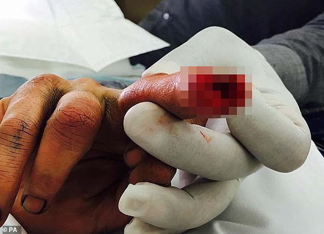 Johnny Depp releases photo of his severed finger