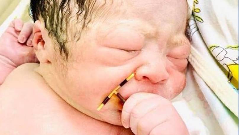 Obstetrician clicked the photo of this newborn baby with the failed coil