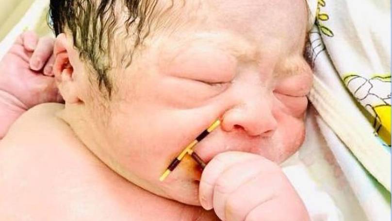 Obstetrician clicked the photo of this newborn baby with the failed coil