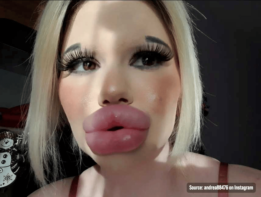 Botox Lips Porn