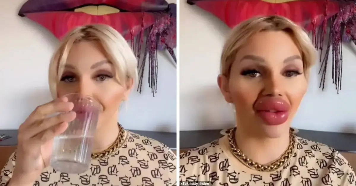 Woman With 30ml Lip Filler Shares The Difficulties She Faces While