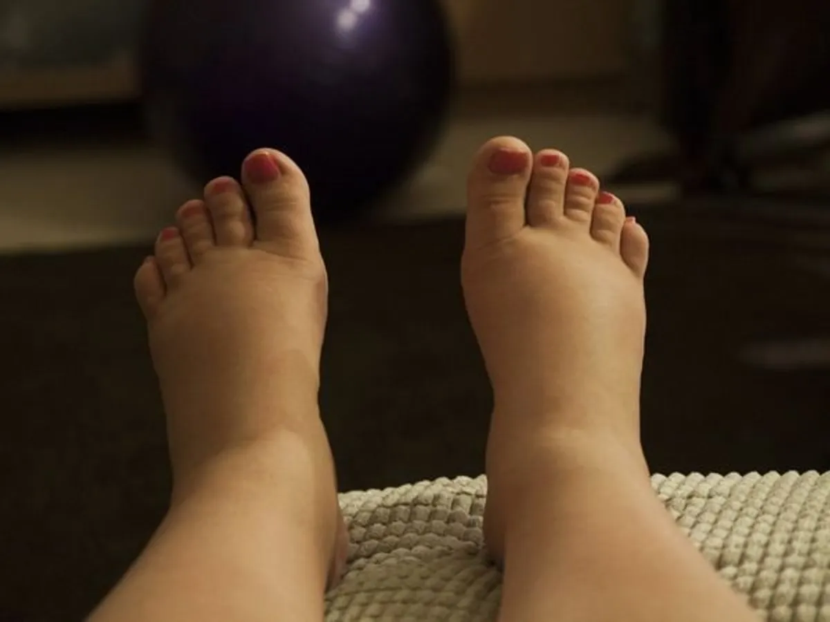 9 Surprising Reasons Your Feet Are Swollen: What They Really Mean for Your Health