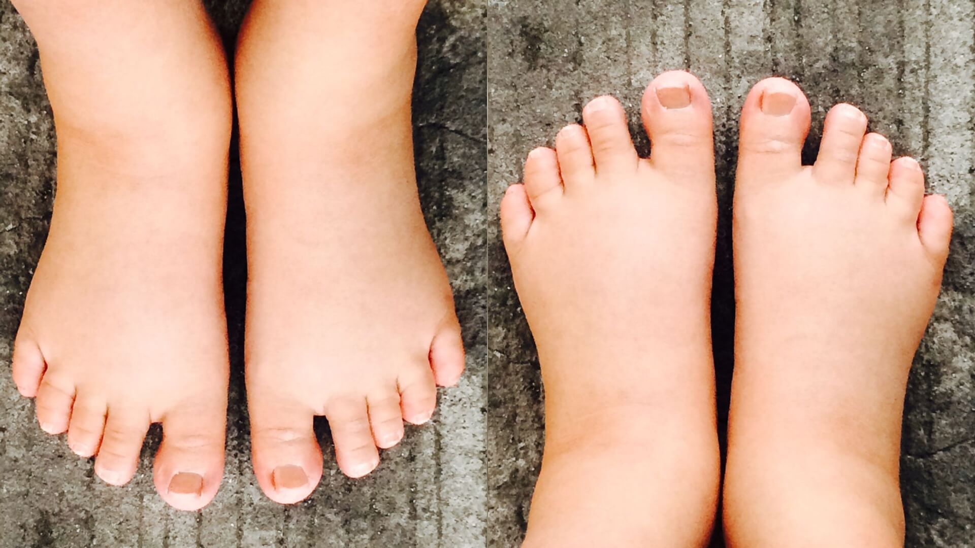 9 Surprising Reasons Your Feet Are Swollen: What They Really Mean for Your Health